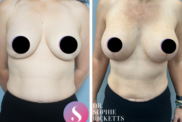 Breast Augmentation + Breast Lift