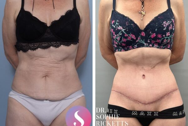 Abdominoplasty