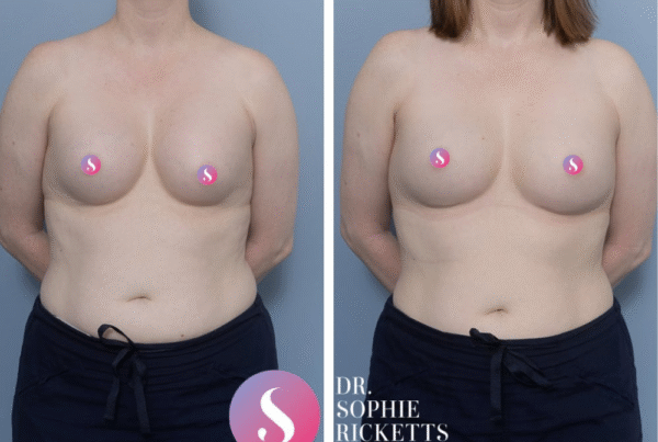 Revision breast augmentation