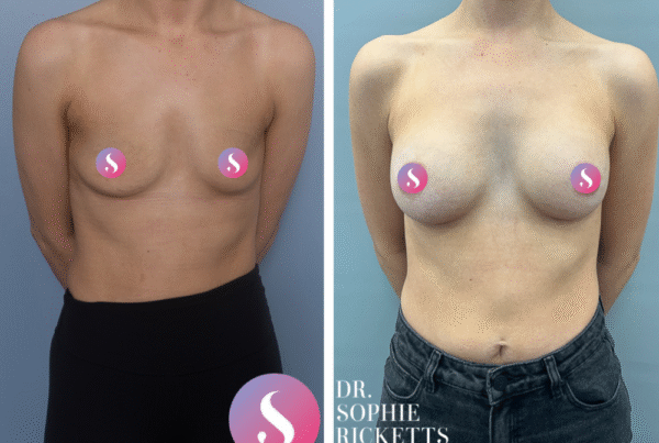 Breast augmentation