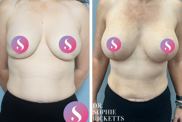 Breast Augmentation and Mastopexy