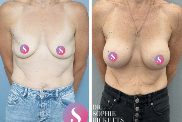 Breast Augmentation