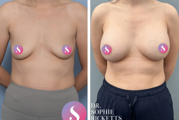 Breast Augmentation