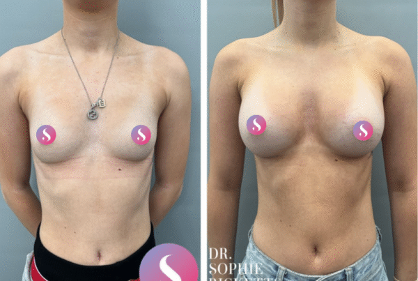 Breast Augmentation