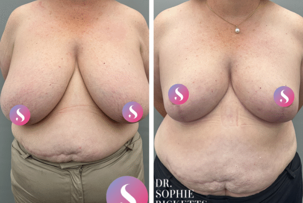 Breast Reduction