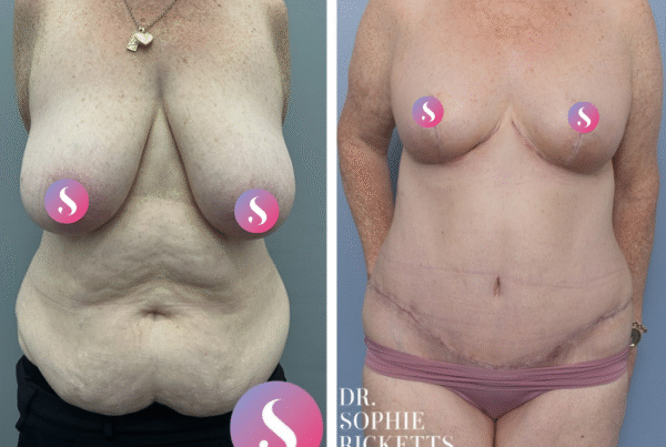 Breast Reduction and Abdominoplasty