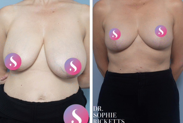 Breast Reduction