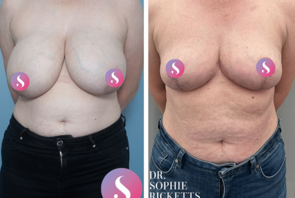 Breast Reduction