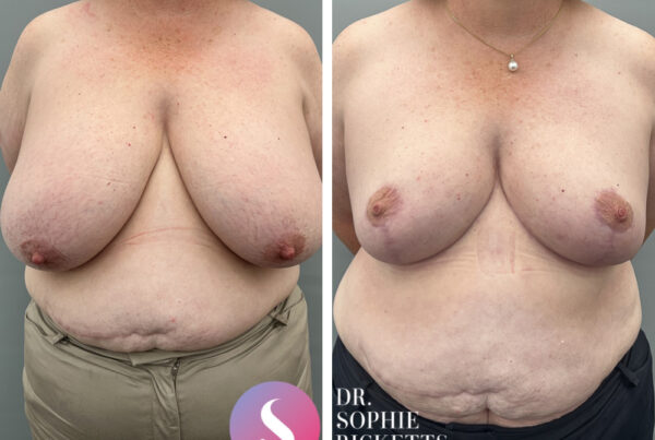 Bilateral Breast Reduction