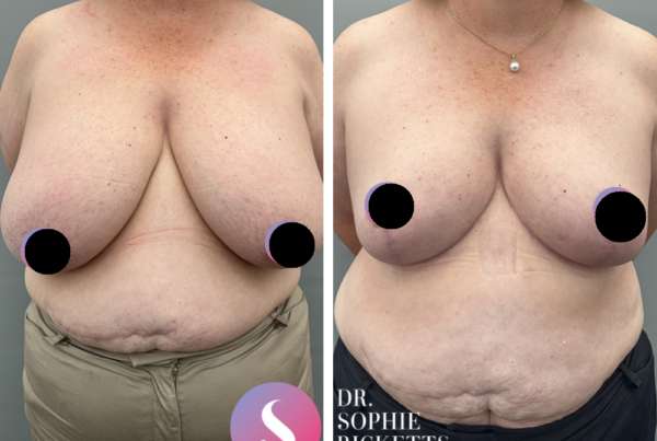 Breast Reduction