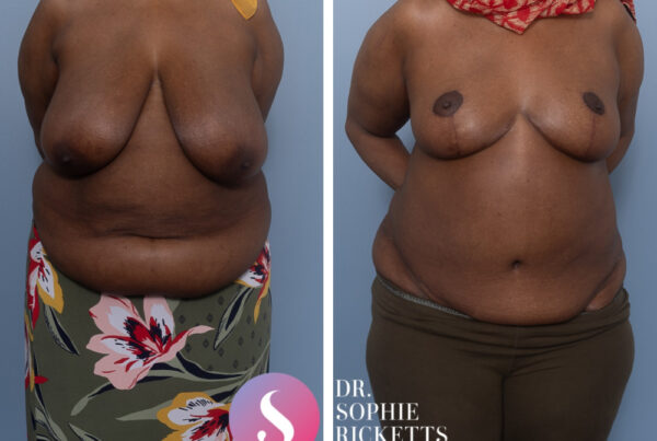 Breast reduction & abdominoplasty