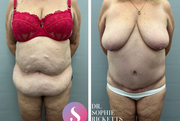 Abdominoplasty