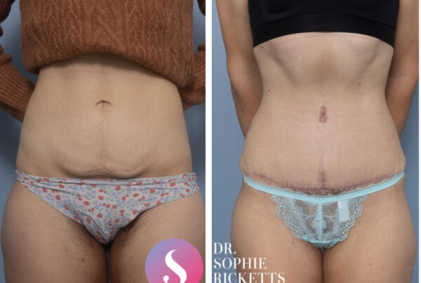 Abdominoplasty