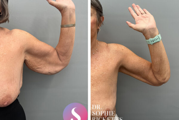 Brachioplasty