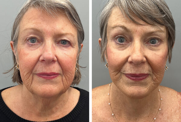 Face and Neck Lift Surgery