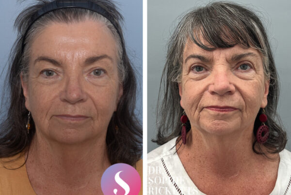 Upper blepharoplasty
