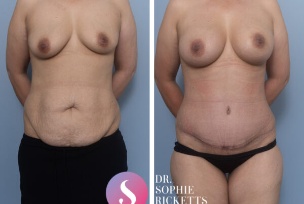 Post pregnancy surgery