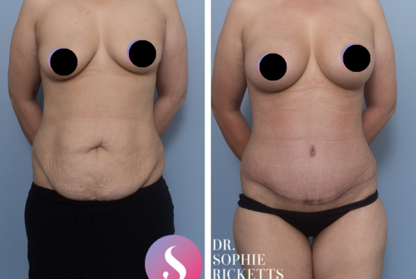 Post Pregnancy Surgery