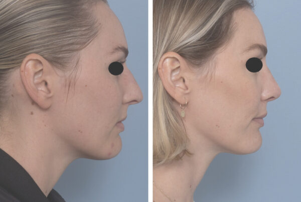 Rhinoplasty