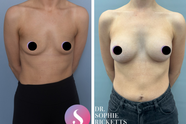 Breast Augmentation