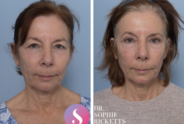 Blepharoplasty