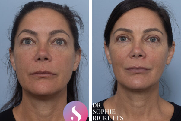 Blepharoplasty