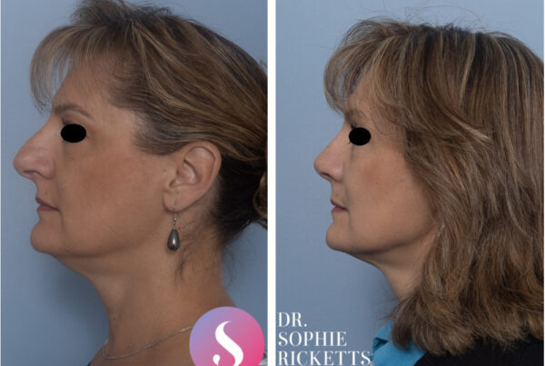 Rhinoplasty