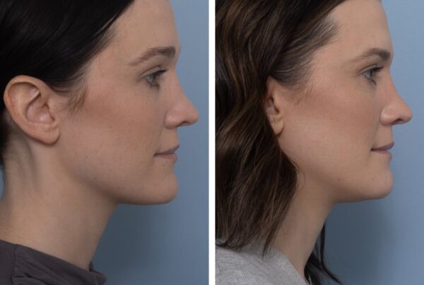 Chin reduction