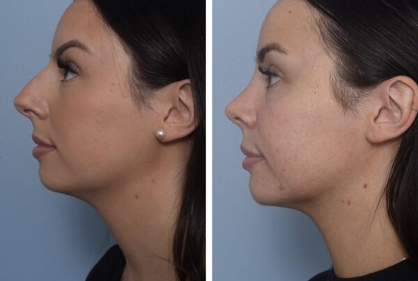 Rhinoplasty