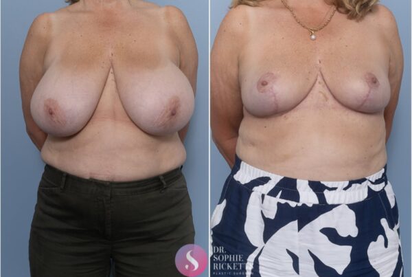 Bilateral breast reduction