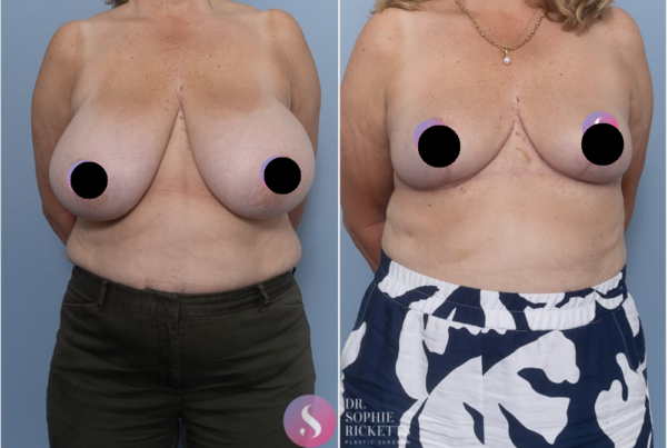 Breast Reduction