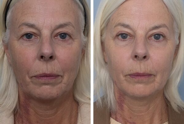 Upper blepharoplasty