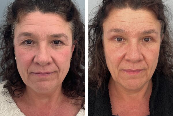 Temporal brow lift and upper blepharoplasty