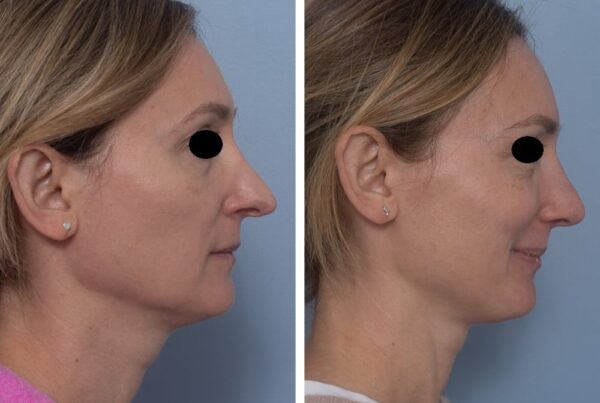 Open rhinoplasty