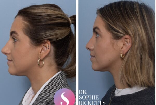 Open Rhinoplasty