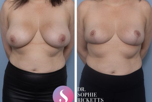 Breast reduction