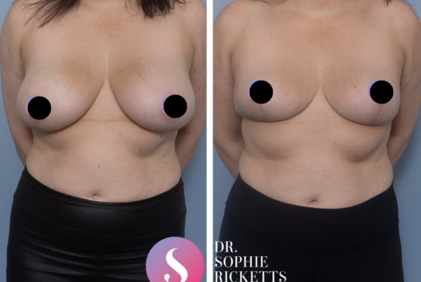Breast Reduction