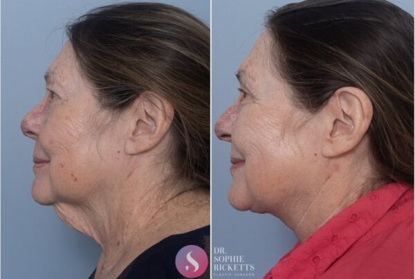 Brow lift