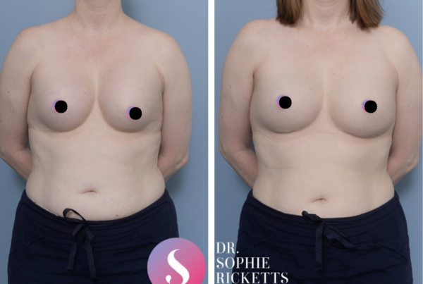 Revision Breast Augmentation