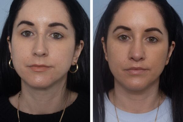 Lip lift