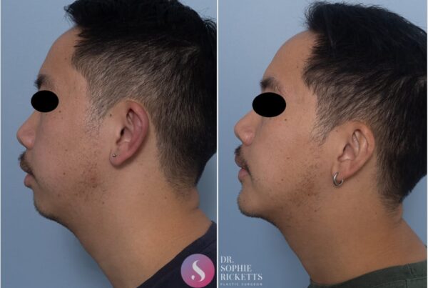 Chin augmentation