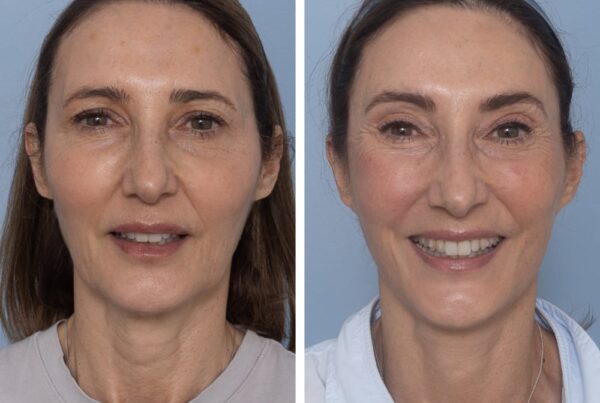 Face and neck lift