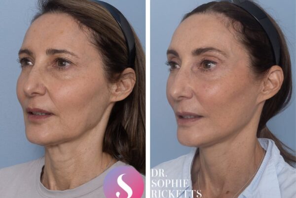 Face and Neck Lift Surgery