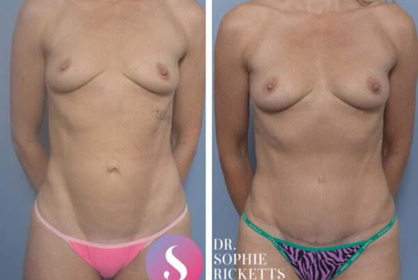 Abdominoplasty