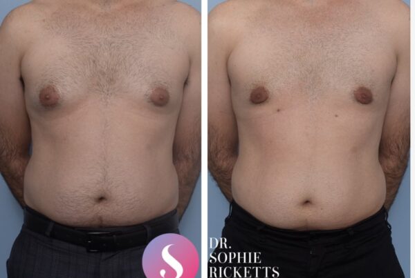 Gynaecomastia