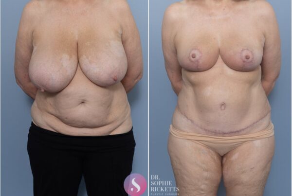 Post Pregnancy Surgery